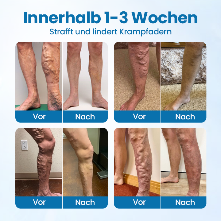 Cvreoz® VeinGuard Kräuterspray-✅Klinisch erwiesen, um Krampfadern in nur 7 Tagen zu beseitigen!!